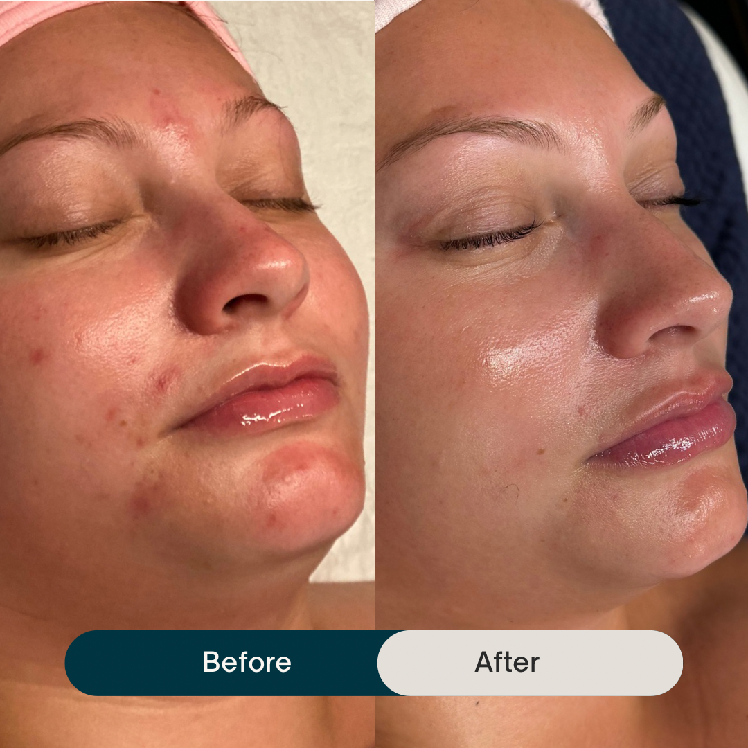 Why We Don't Always Start With Retinoids
