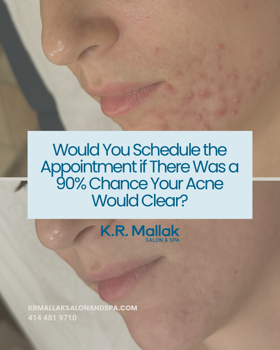 If There Was a 90% Chance Your Acne Would Clear, Would You Start Today?